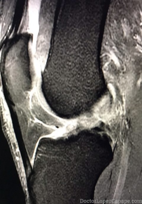 Rotura Del Ligamento Cruzado Anterior De La Rodilla Biclinic